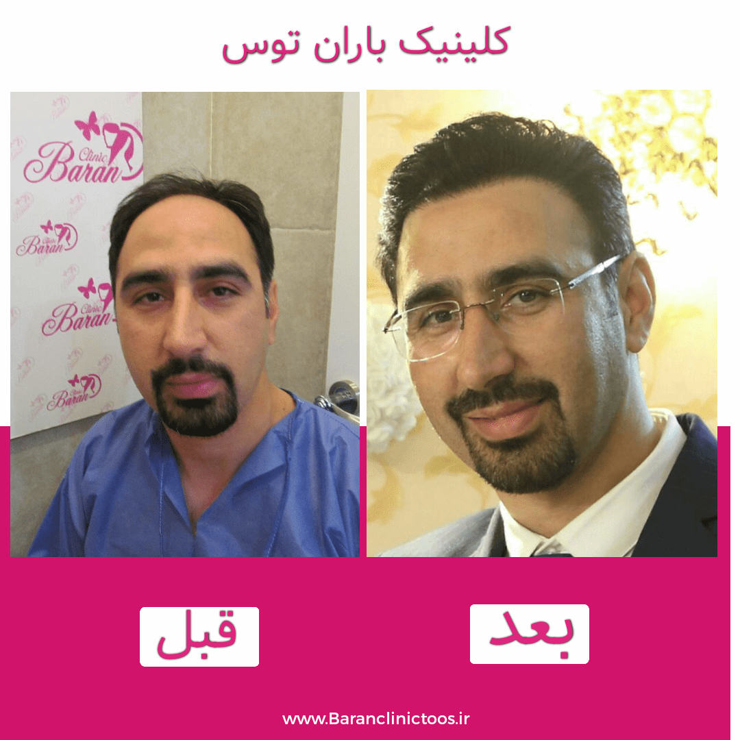 قبل و بعد کاشت مو